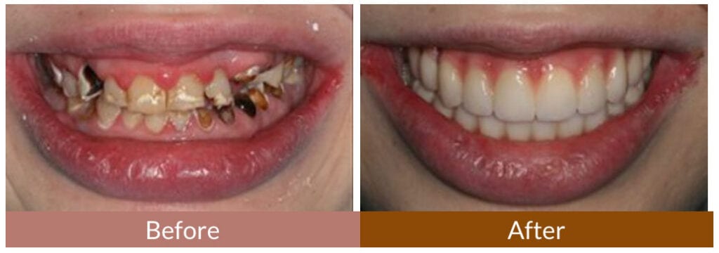 Before-After Smile Gallery