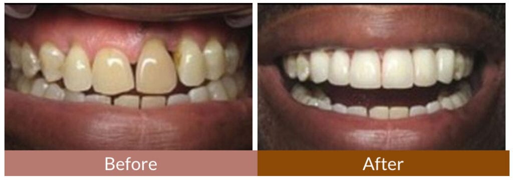 Before-After Smile Gallery