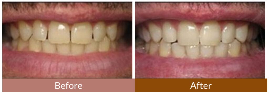 Before-After Smile Gallery