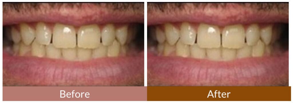 Before-After Smile Gallery