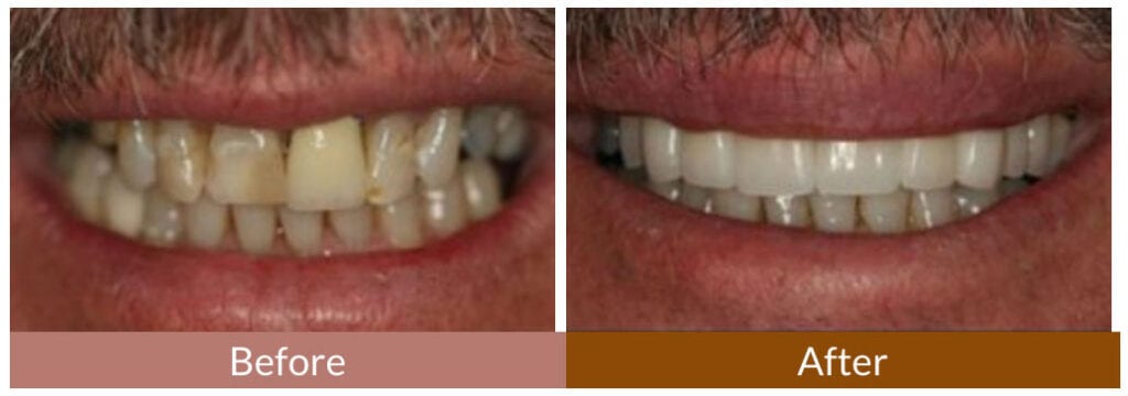 Before-After Smile Gallery