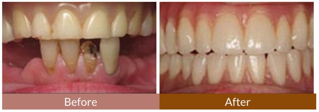 Before-After Smile Gallery