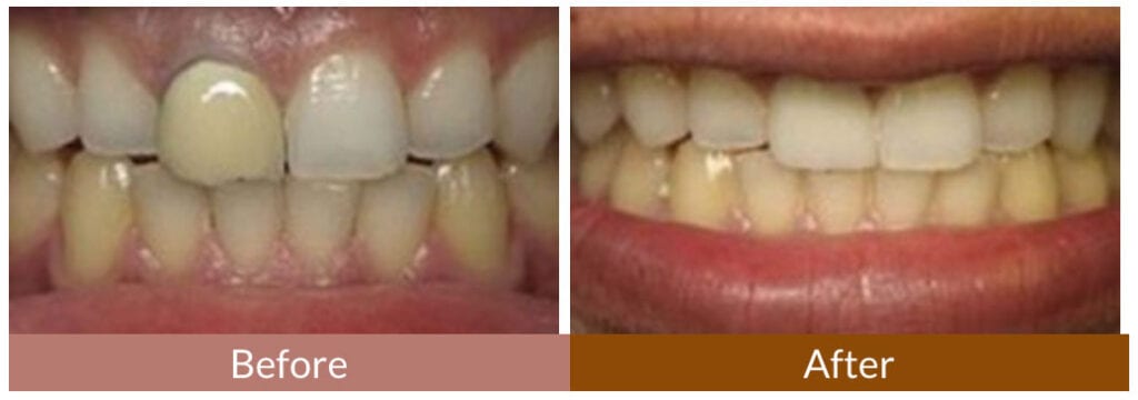 Before-After Smile Gallery