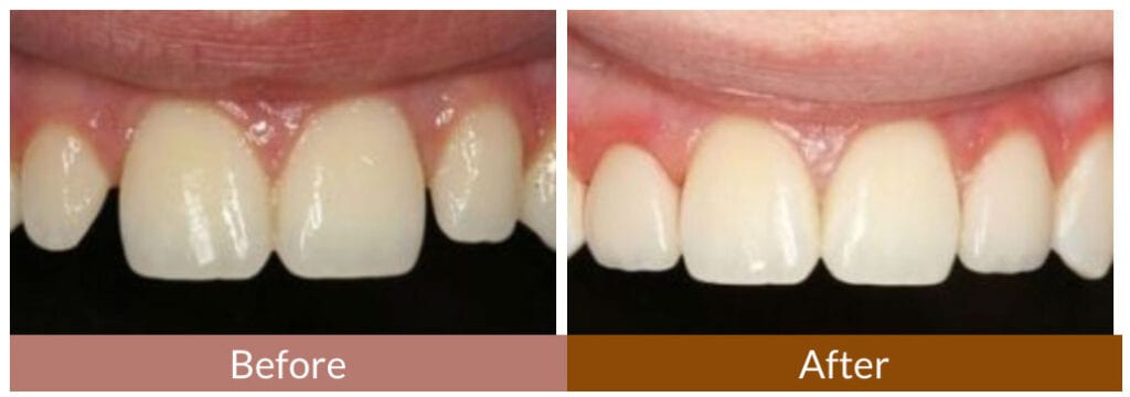 Before-After Smile Gallery