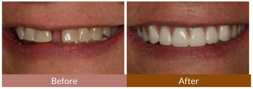 Before-After Smile Gallery