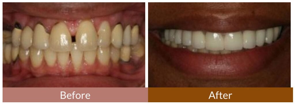 Before-After Smile Gallery