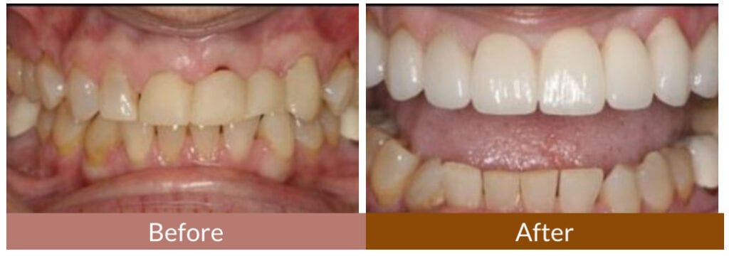 Before-After Smile Gallery