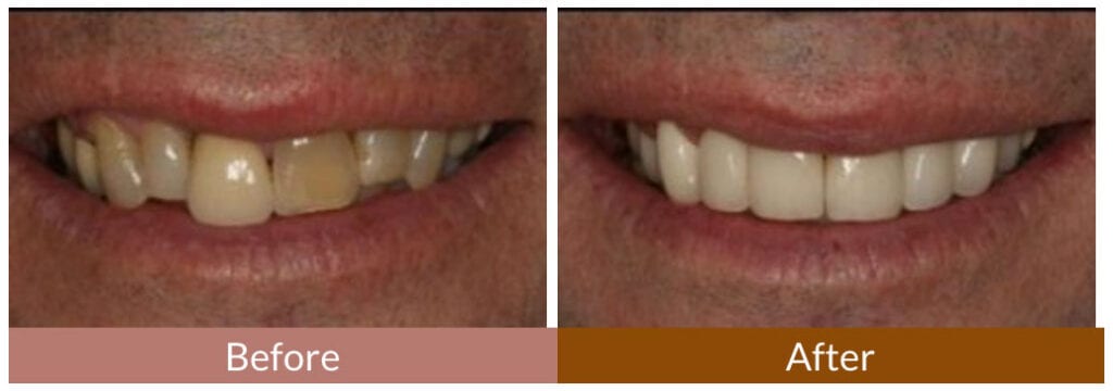 Before-After Smile Gallery