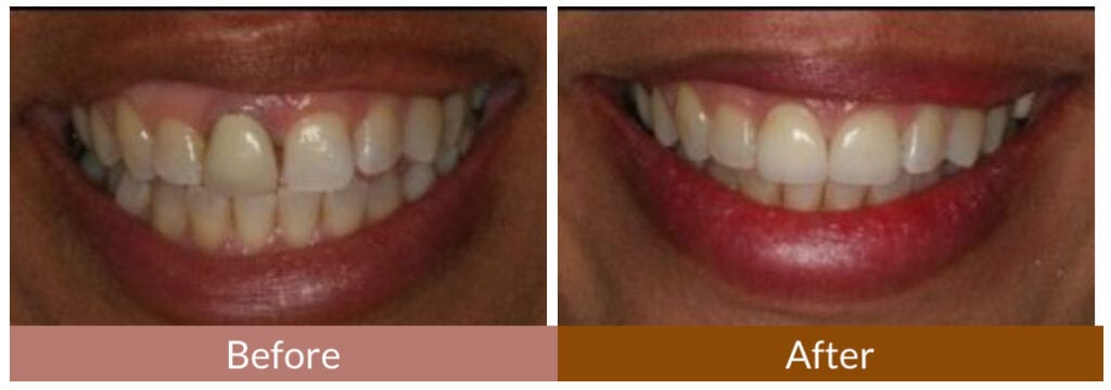 Before-After Smile Gallery